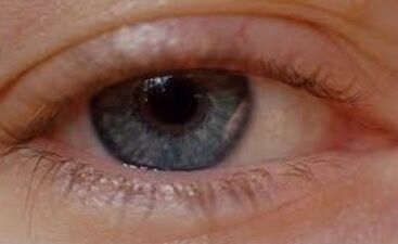 Oculax izārstēts blefarīts